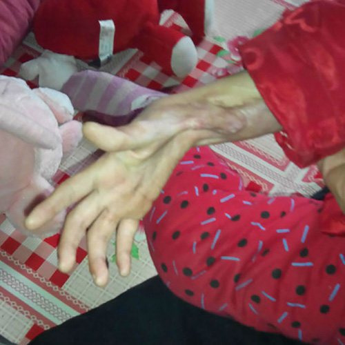 妤心植皮后，出現(xiàn)了非常嚴(yán)重的疤痕增生現(xiàn)象